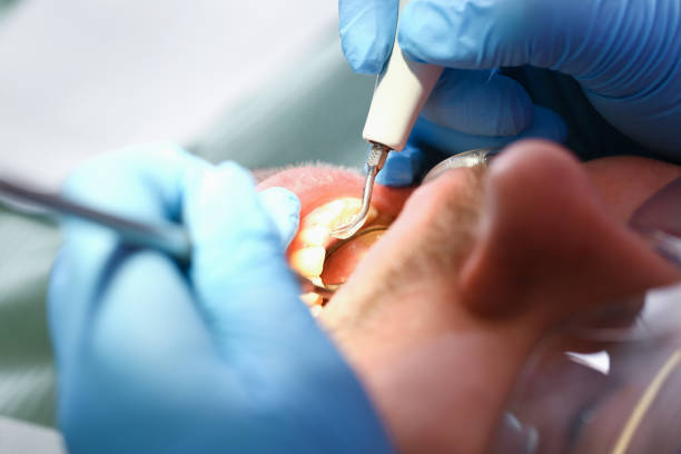 Best Emergency Dental Filling Replacement  in Addis, LA
